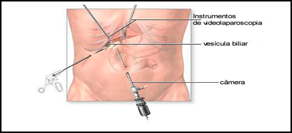 Cirurgia Videolaparoscópica485