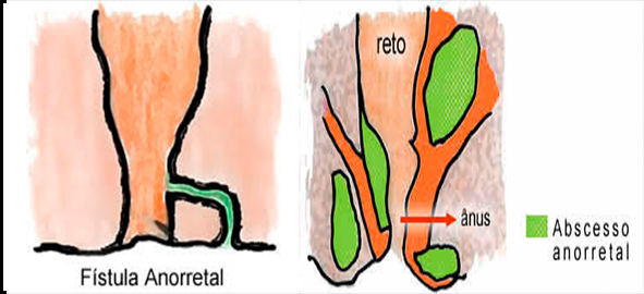 Fístula anal239-b