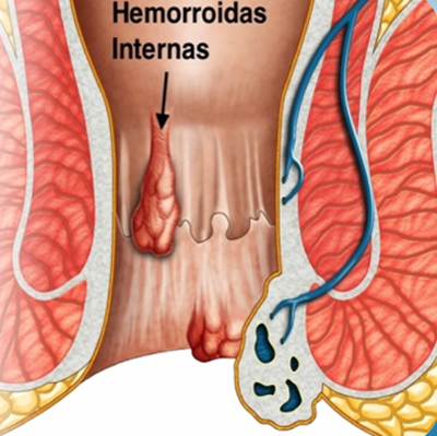 hemorroidas fatores causais