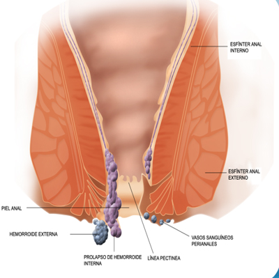 hemorroidas sintomas